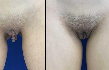 Female Patient Before & After Labiaplasty