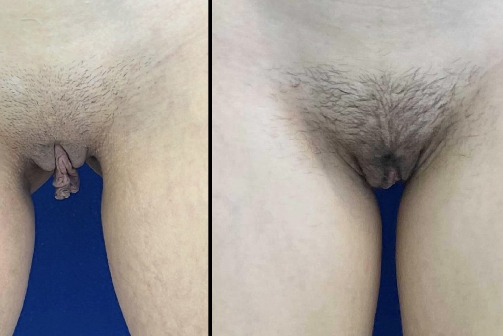 Female Patient Before & After Labiaplasty