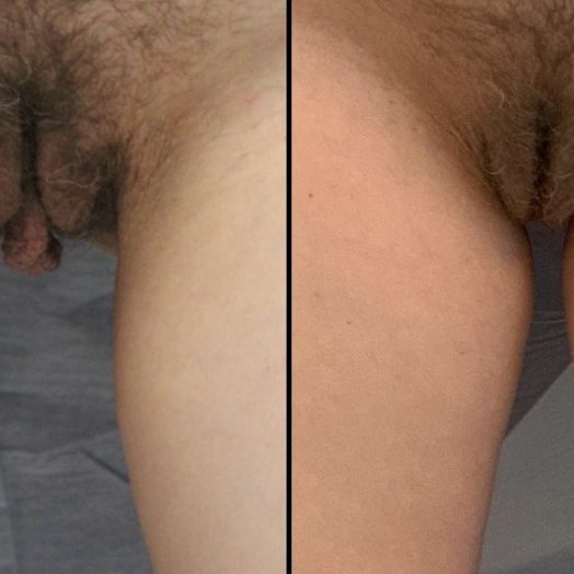 Female Patient Before & After Labiaplasty