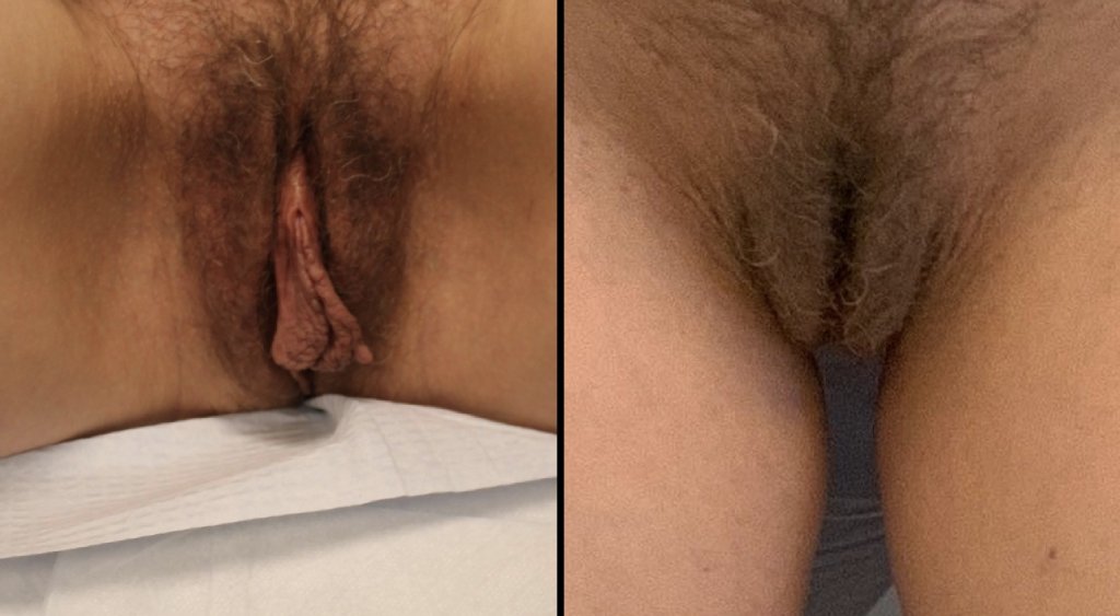 Female Patient Before & After Labiaplasty