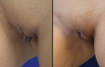 Female Patient Before & After Labiaplasty