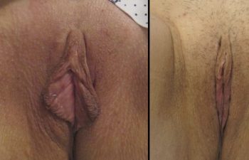 Female Patient Before & After Labiaplasty