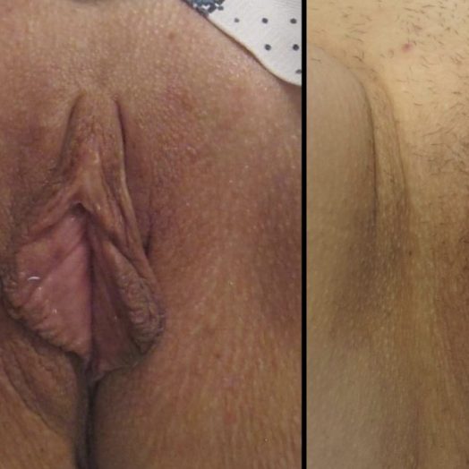 Female Patient Before & After Labiaplasty