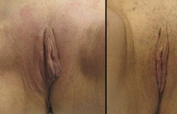 Female Patient Before & After Labiaplasty