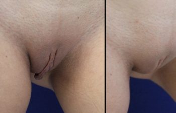 Female Patient Before & After Labiaplasty