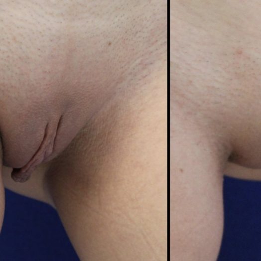 Female Patient Before & After Labiaplasty