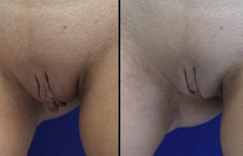 Female Patient Before & After Labiaplasty