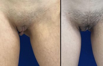 Female Patient Before & After Labiaplasty