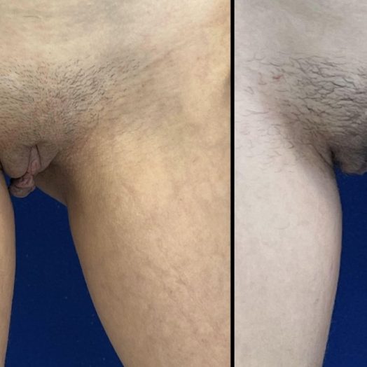 Female Patient Before & After Labiaplasty