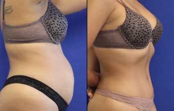 43 year-old , before and after abdominoplasty and liposuction for the flanks, abdomen, back, inner and outer thighs