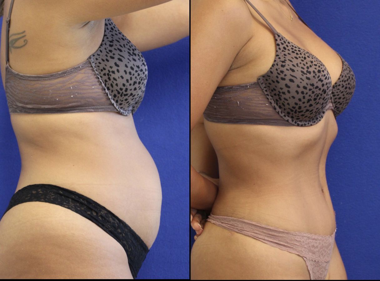 43 year-old , before and after abdominoplasty and liposuction for the flanks, abdomen, back, inner and outer thighs
