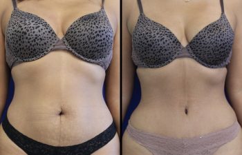 43 year-old , before and after abdominoplasty and liposuction for the flanks, abdomen, back, inner and outer thighs