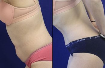 54 year-old before and after abdominoplasty