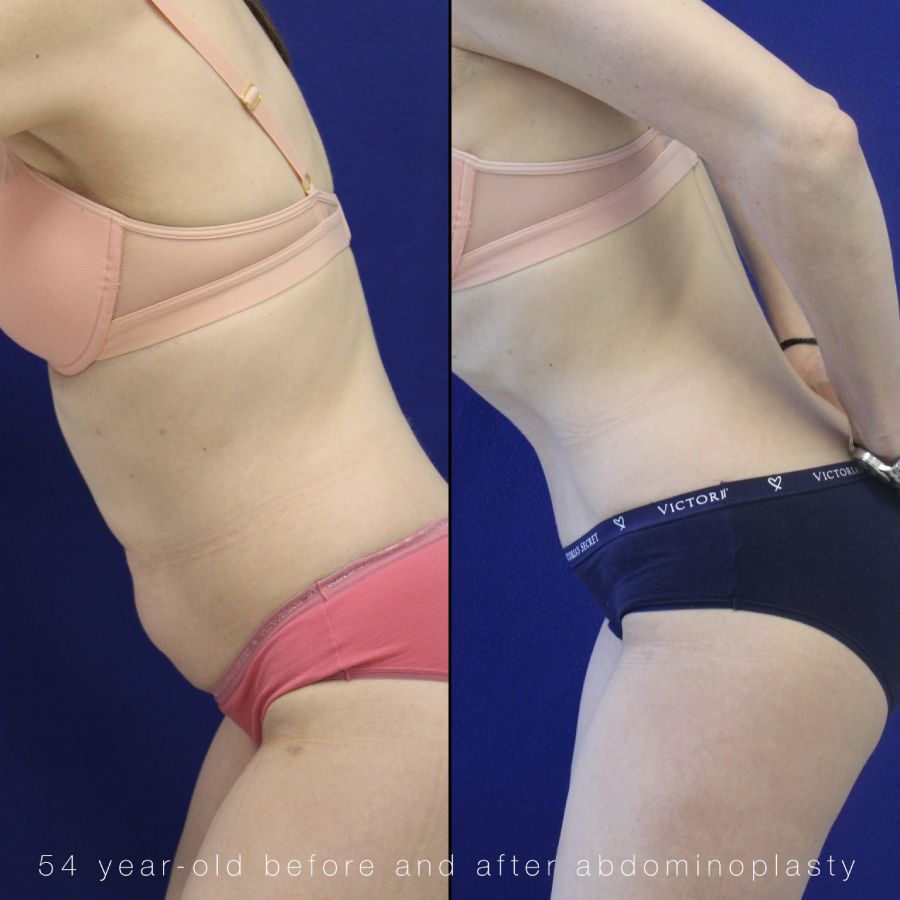 54 year-old before and after abdominoplasty