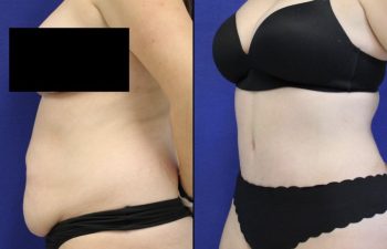 Tummy Tuck / Abdominoplasty Before & After Photos
