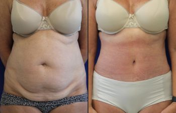 61 year-old patient 4 weeks after her abdominoplasty, flanks liposuction and hernia repair. Swelling is still present. Final results can usually be seen 3 months after surgery.
