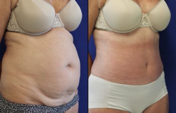61 year-old patient 4 weeks after her abdominoplasty, flanks liposuction and hernia repair. Swelling is still present. Final results can usually be seen 3 months after surgery.