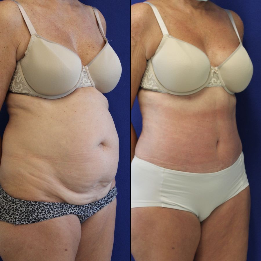 61 year-old patient 4 weeks after her abdominoplasty, flanks liposuction and hernia repair. Swelling is still present. Final results can usually be seen 3 months after surgery.