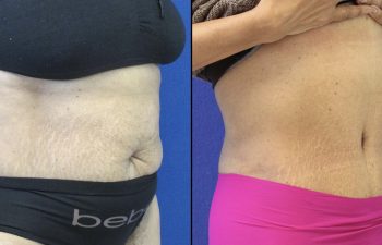 55 year-old patient before and after abdominoplasty and flanks liposuction