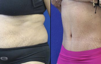 55 year-old patient before and after abdominoplasty and flanks liposuction