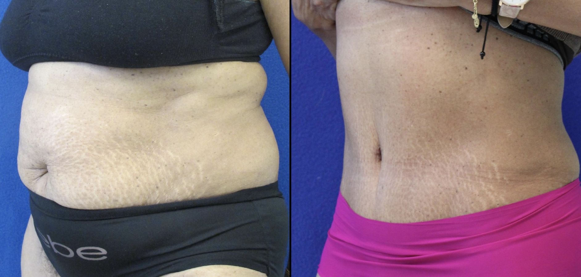 55 year-old patient before and after abdominoplasty and flanks liposuction