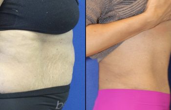 55 year-old patient before and after abdominoplasty and flanks liposuction