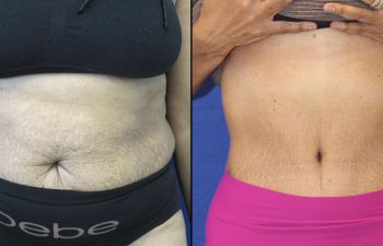 55 year-old patient before and after abdominoplasty and flanks liposuction