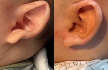 Before & After Ear Shaping