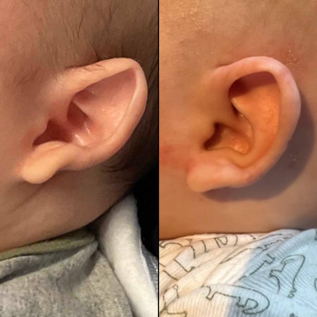 Before & After Ear Shaping