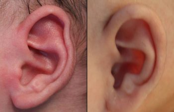 Before & After Ear Shaping