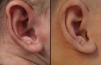 Before & After Ear Shaping
