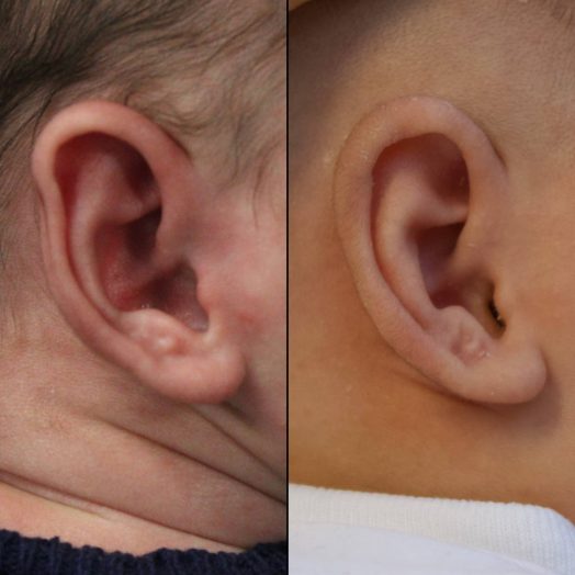 Before & After Ear Shaping