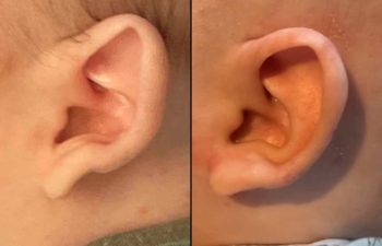 Before & After Ear Shaping