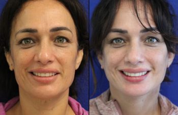 46 year-old patient before and after two weeks after a mini neck lift