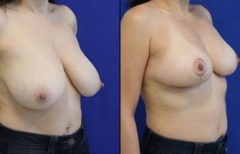 42 year old patient before and one month after breast reduction