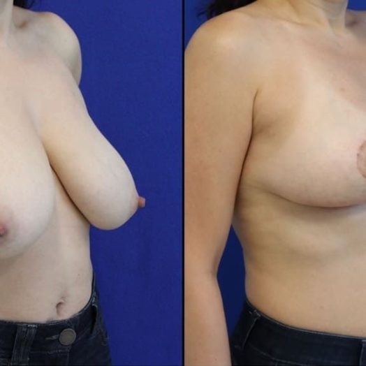 42 year old patient before and one month after breast reduction