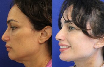 46 year-old patient before and after two weeks after a mini neck lift