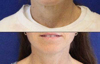52 year-old before and after mini facelift, mini neck lift and TCA peel