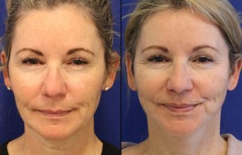 Mini Facelift - Maia Plastic Surgery