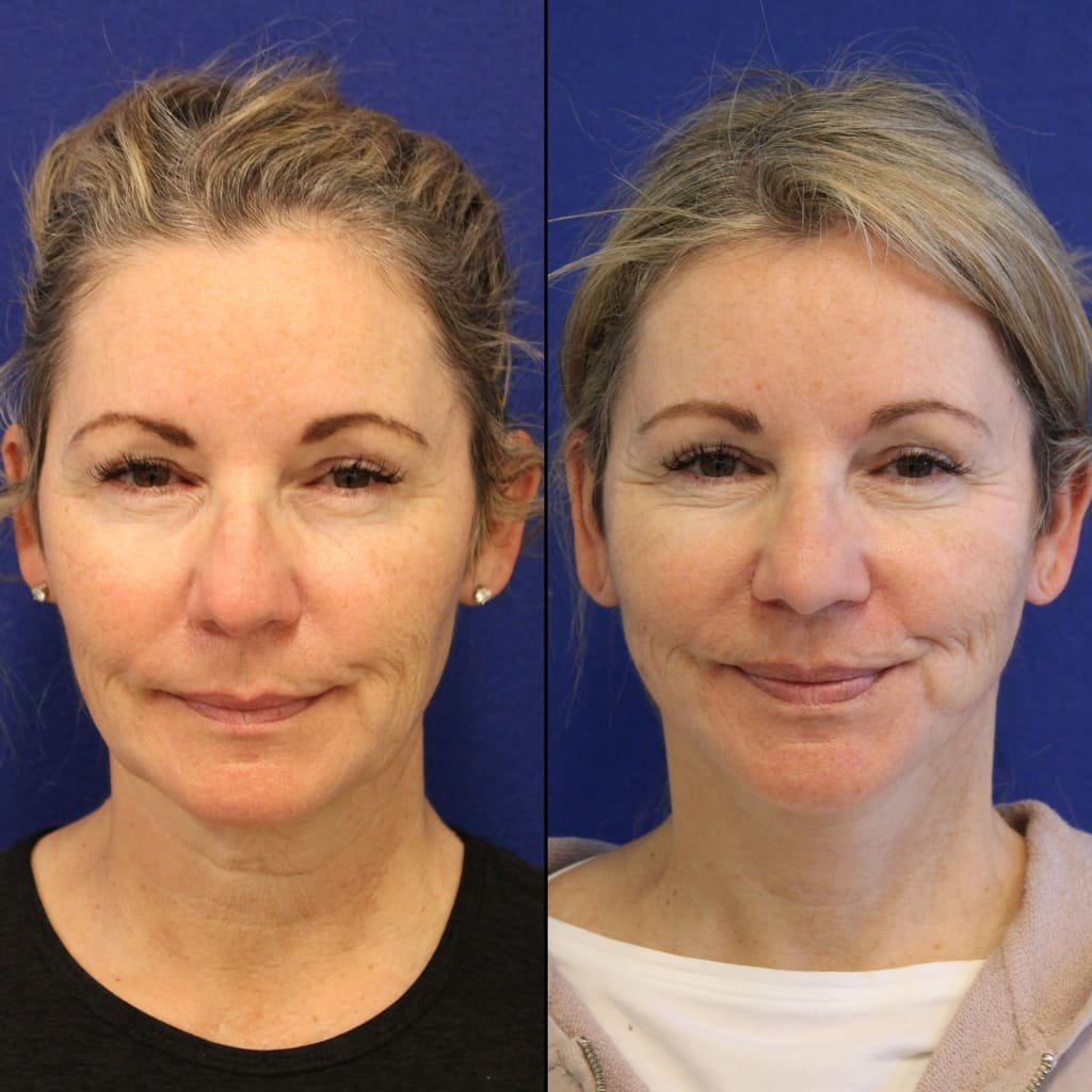 56 year-old patient before and two weeks after mini facelift, mini neck lift and TCA peel