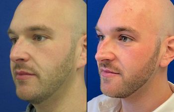 Our 33 year-old patient was concerned with the appearance of his neck despite weight loss and exercise. Dr. Maia performed a mini neck lift and neck liposuction to achieve the appearance he was looking for. Scars will fade away over time