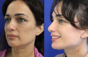 46 year-old patient before and after two weeks after a mini neck lift