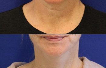 56 year-old patient before and two weeks after mini facelift, mini neck lift and TCA peel
