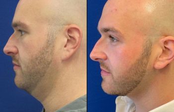 Our 33 year-old patient was concerned with the appearance of his neck despite weight loss and exercise. Dr. Maia performed a mini neck lift and neck liposuction to achieve the appearance he was looking for. Scars will fade away over time