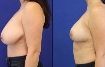 42 year-old before and 1 month after breast reduction