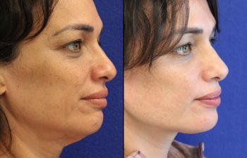 46 year-old patient before and after two weeks after a mini neck lift