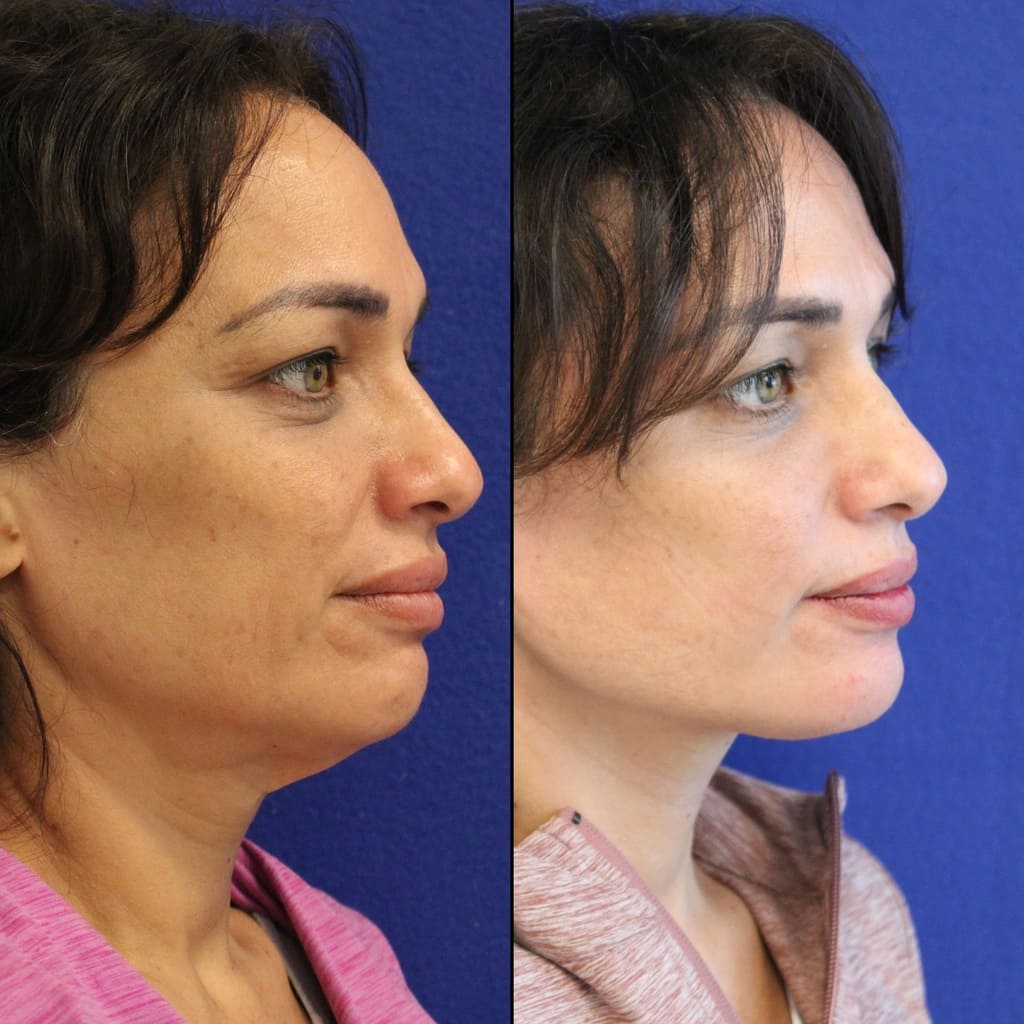 46 year-old patient before and after two weeks after a mini neck lift