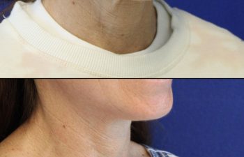 52 year-old before and after mini facelift, mini neck lift and TCA peel