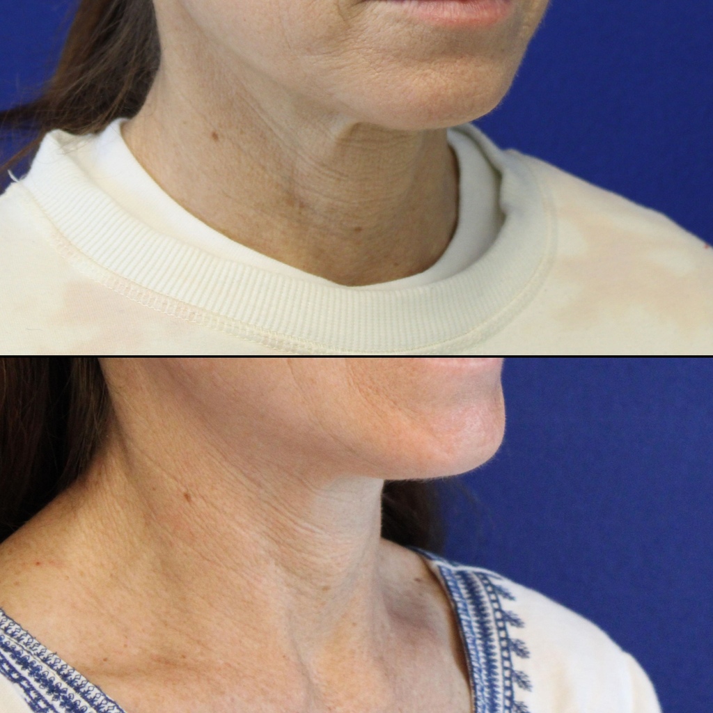 52 year-old before and after mini facelift, mini neck lift and TCA peel