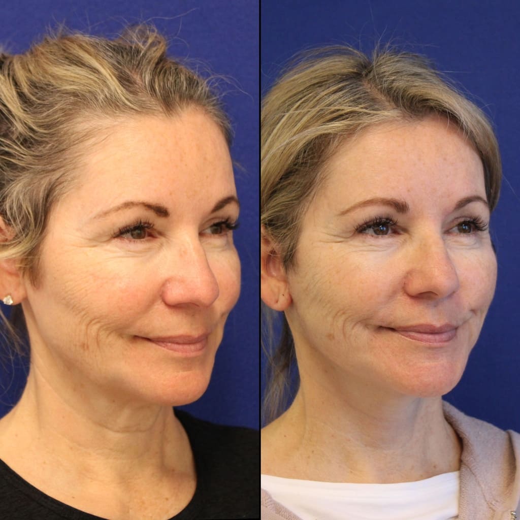 56 year-old patient before and two weeks after mini facelift, mini neck lift and TCA peel